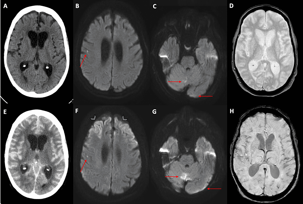 Subarachnoid hemorrhage MRI - Questions and Answers ​in MRI