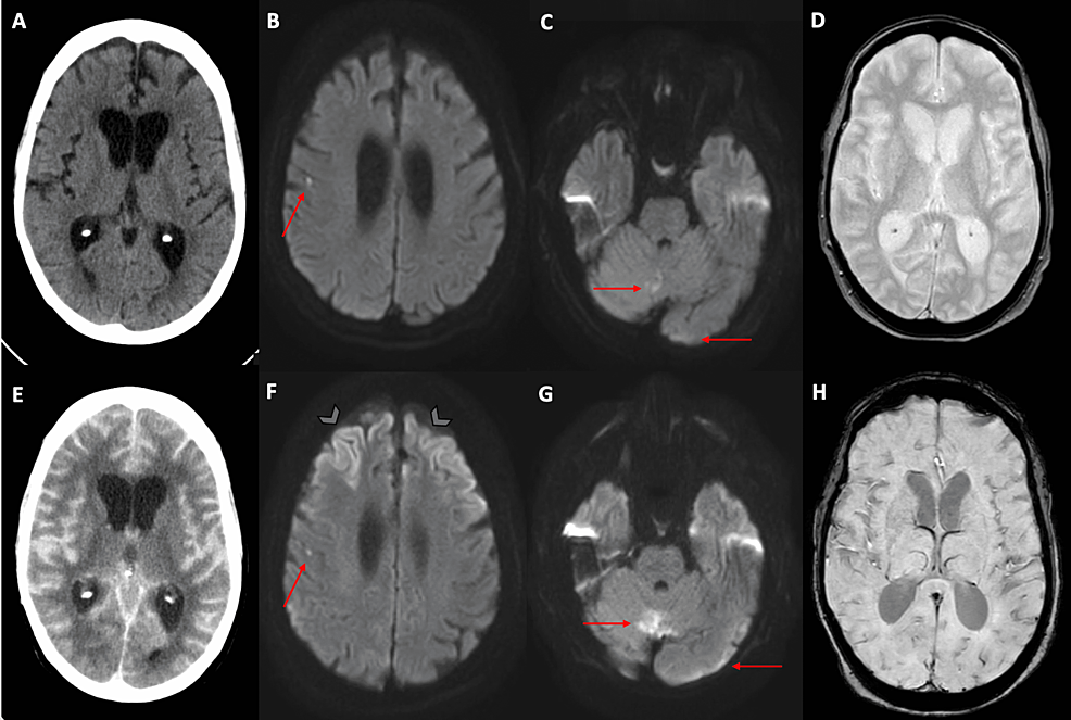 Subarachnoid hemorrhage  Radiology Reference Article