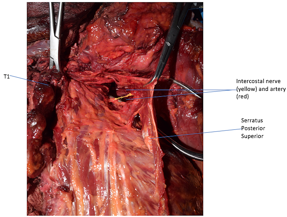 Cureus, Brainstem and Spinal Arachnoiditis Ossificans Associated With  Neurocysticercosis: A Case Report