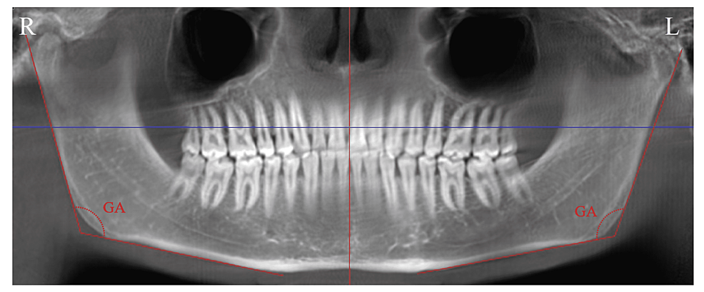 Measurement-of-the-gonial-angle-on-CBCT-images
