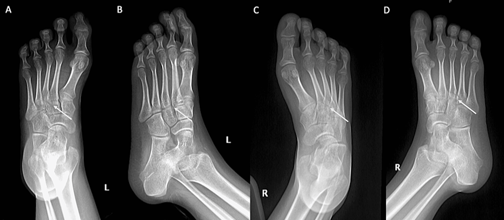 Cureus | Bilateral Lisfranc Injury in a Young Female: A Case Report