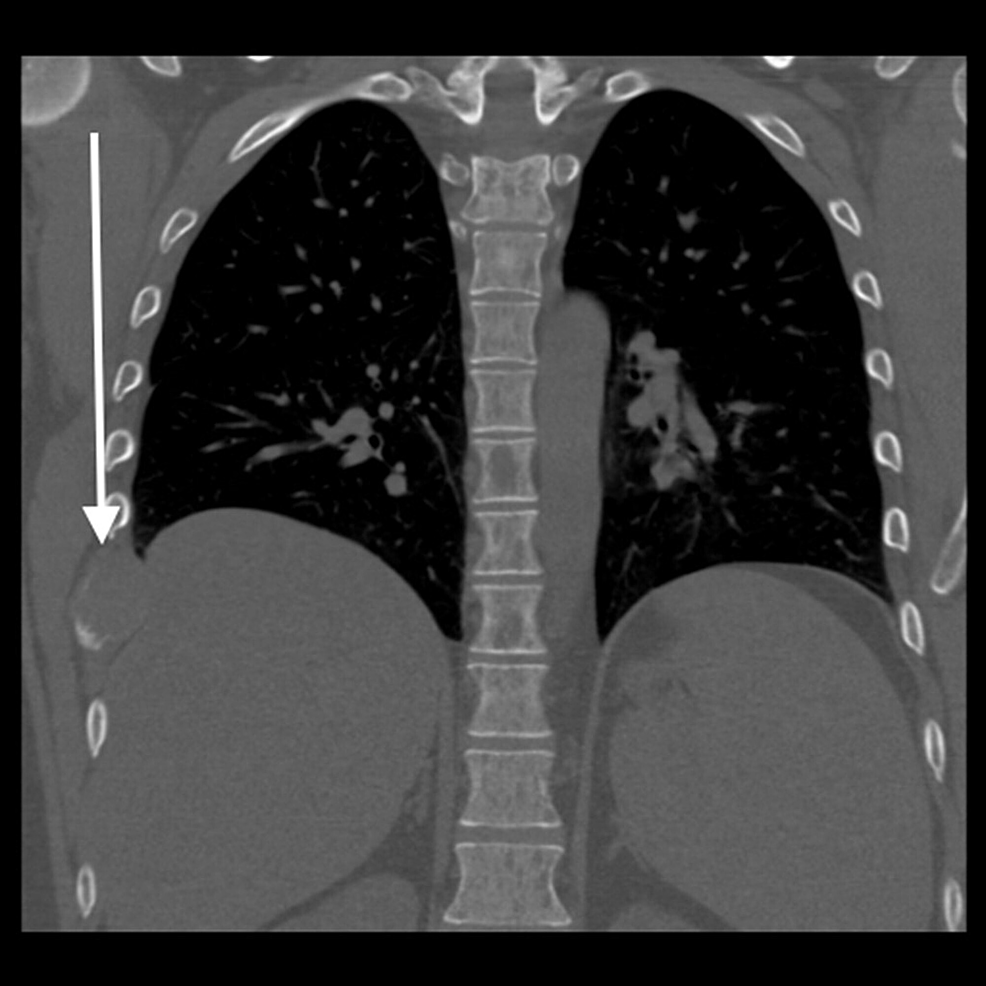 Coronal-CT-image-on-bone-windows-shows-the-lyric-expansive-rib-lesion,-corresponding-to-the-chest-x-ray-abnormality.-No-fracture-was-seen.-Pleura-was-normal.