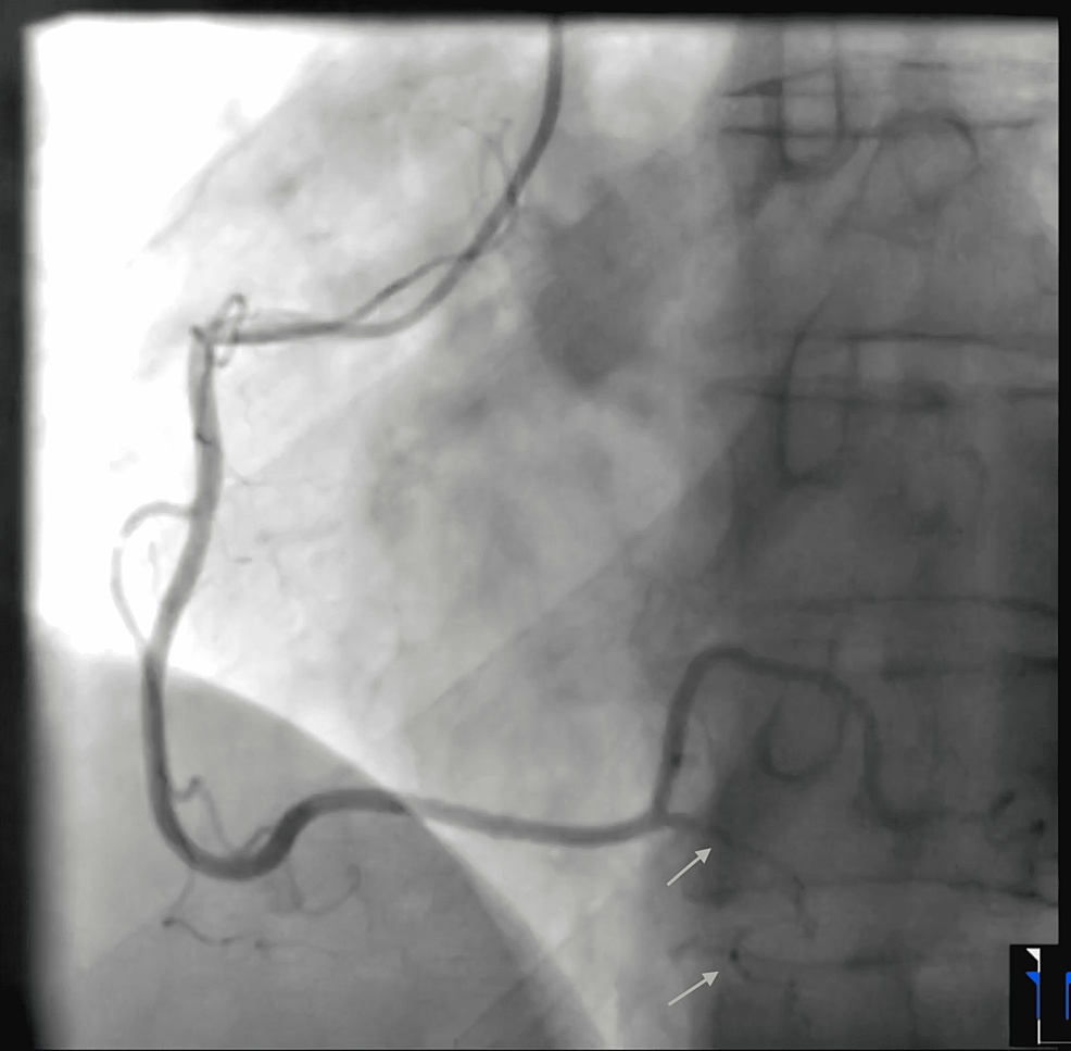 Coronary-angiogram-LAO-view-showing-a-right-posterior-descending-artery-spontaneous-coronary-artery-dissection
