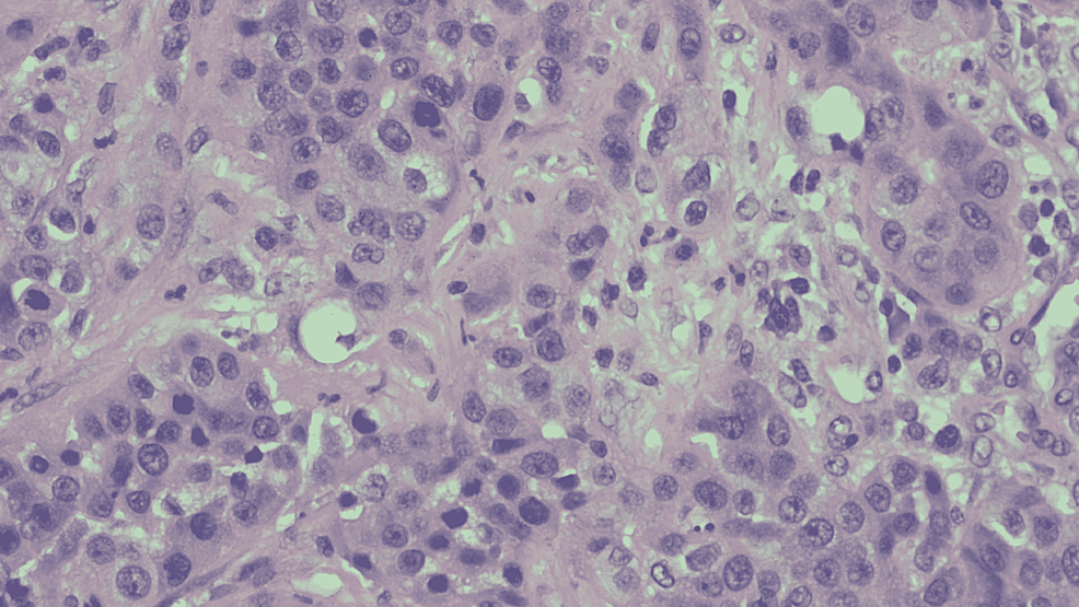 Hematoxylin-and-eosin-(H&E)-stain-of-the-biopsied-mass-at-high-power-magnification.