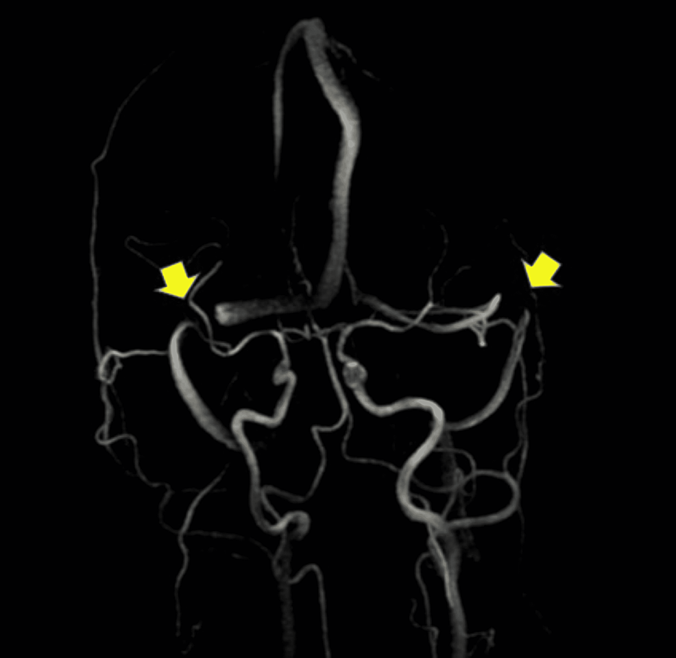 Cerebral-MR-Venography-showing-flow-gap-in-the--right-and-left-transverse-sinus-in-our-patient.