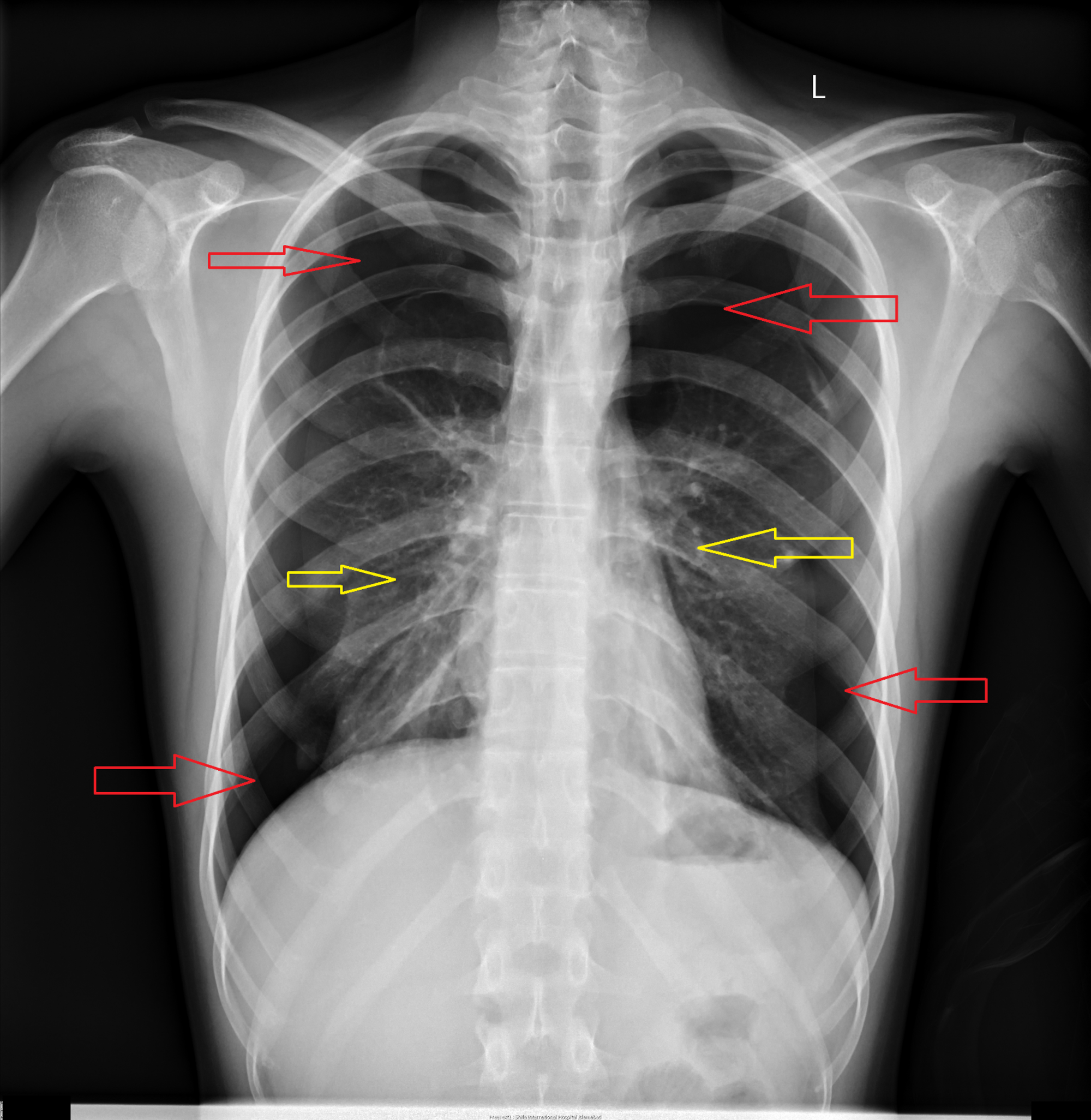 Chest Radiographic Images Of The Pneumothorax Chest Radiograph | Sexiz Pix