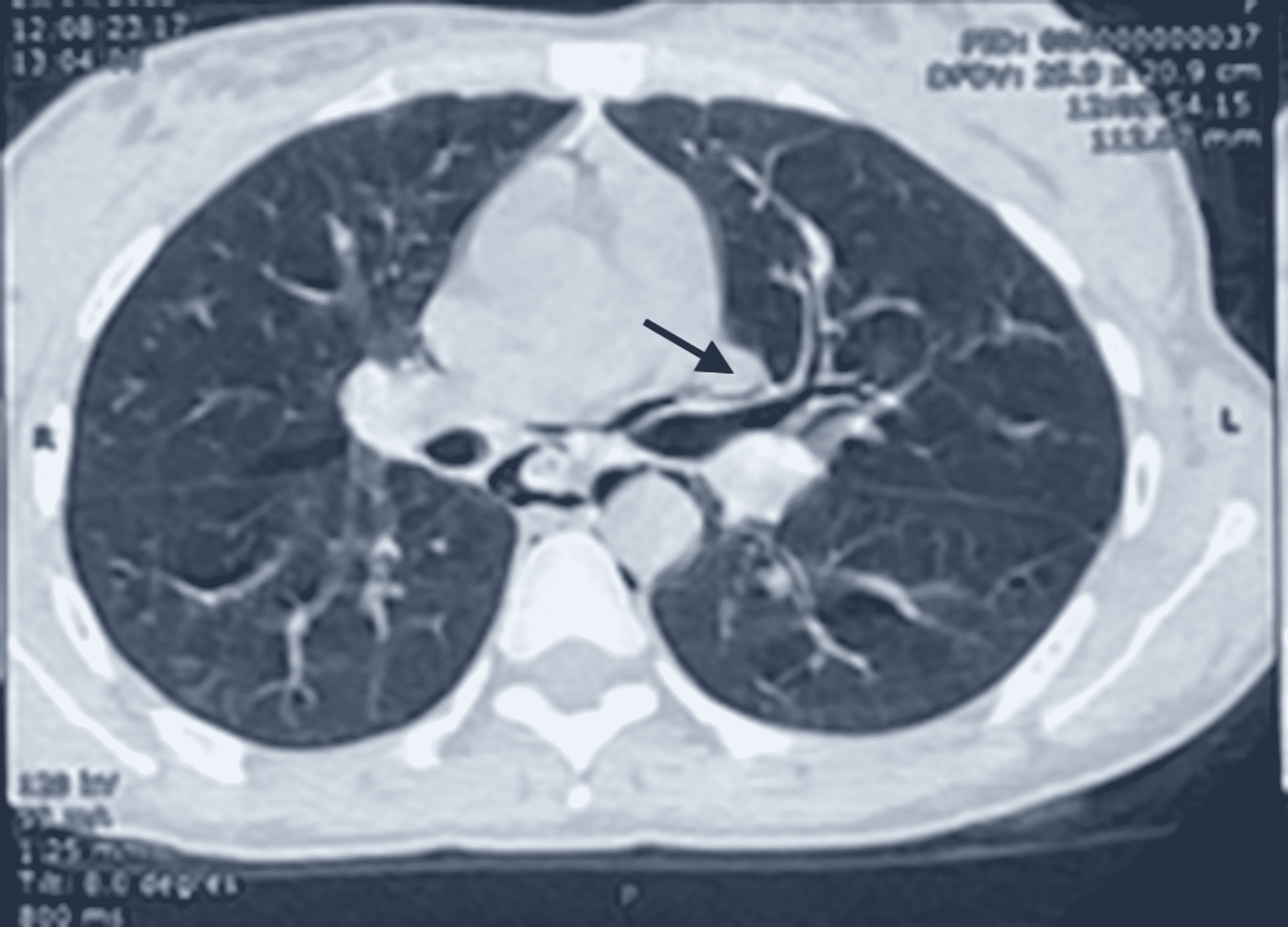 Cureus Spontaneous Pneumomediastinum Revealing Asthma The Macklin Effect