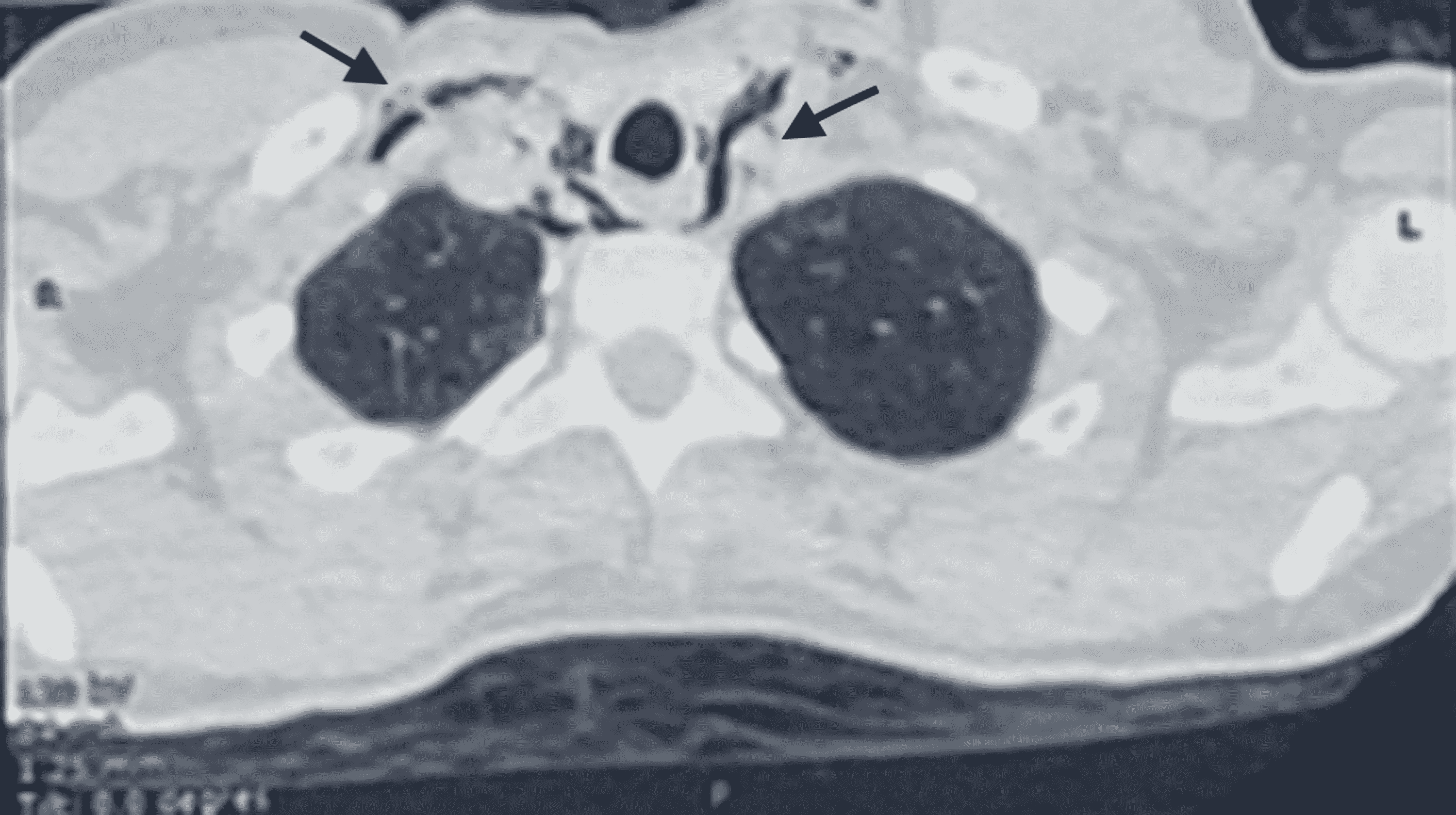 Cureus Spontaneous Pneumomediastinum Revealing Asthma The Macklin Effect
