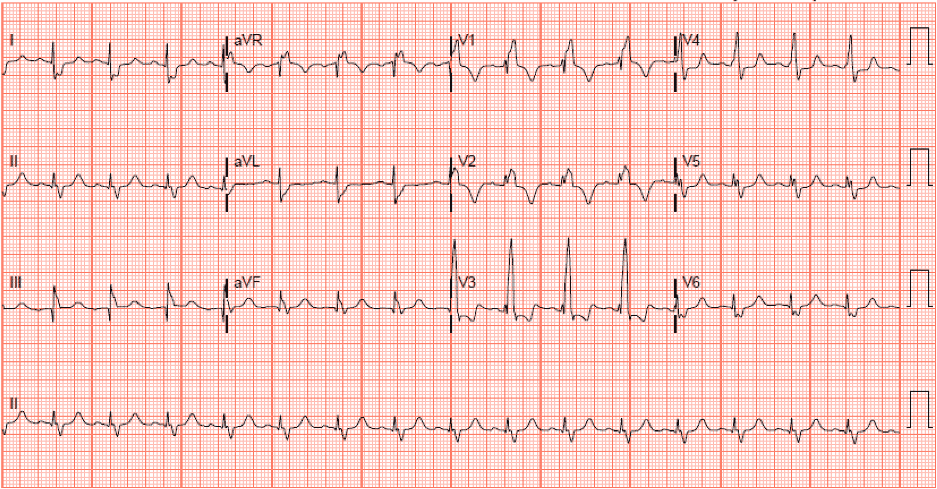 Cureus | Not Your Usual Case of Culture-Negative Endocarditis: A Case ...