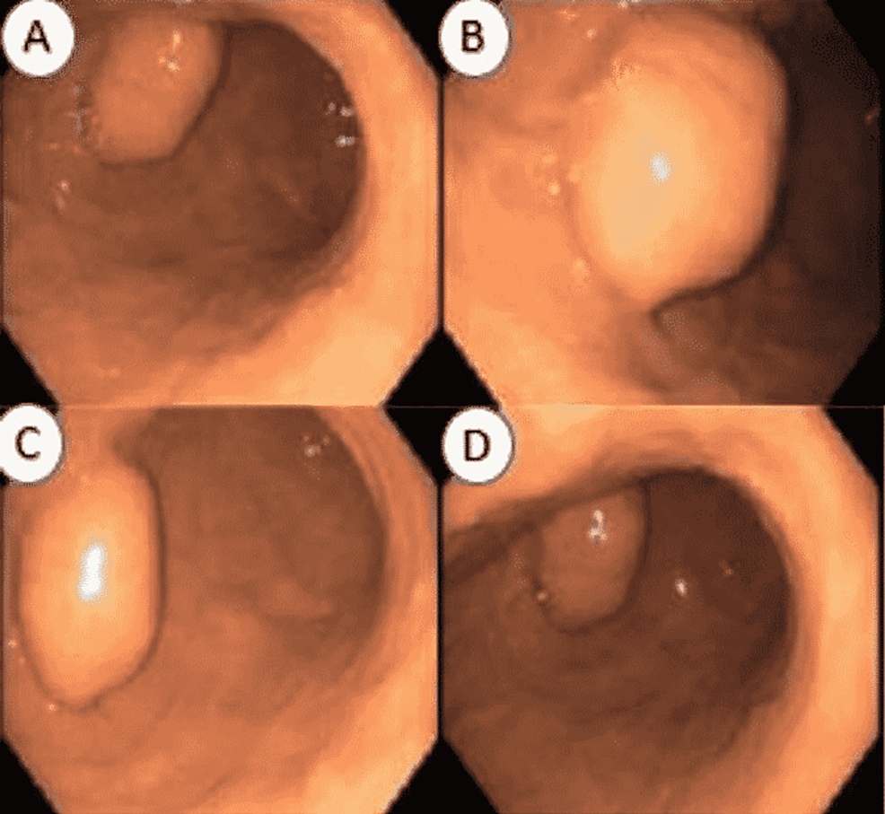 submucosal gastric lesion