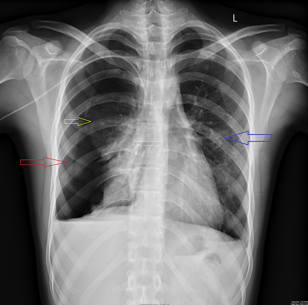 A Chest X Ray Showing Right Sided Pneumothorax Collap - vrogue.co