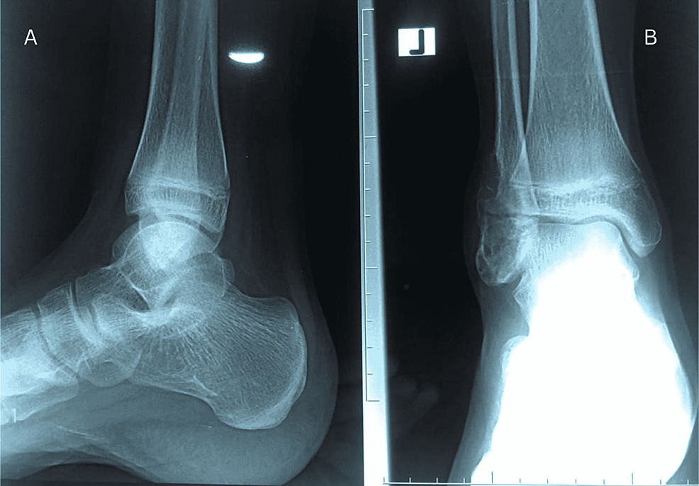 Cureus Giant Cell Tumor Of The Distal Fibula Managed By An Autologous 