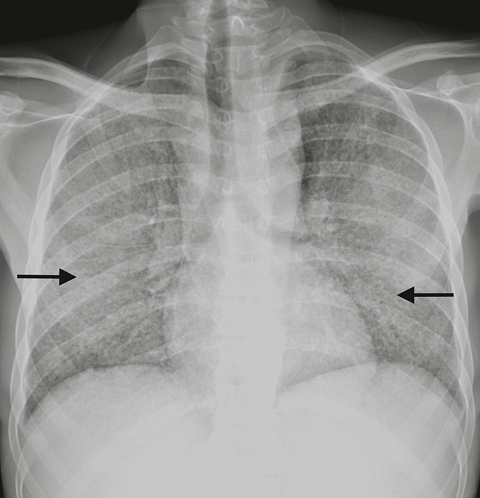 Thoracic-X-ray-on-ICU-admission