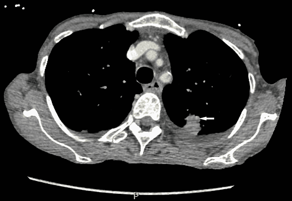CT-scan-of-the-chest-showing-21-mm-(about-0.83-in)-subpleural-density-in-the-posterior-aspect-of-the-left-upper-lobe.-A-white-arrow-shows-subpleural-density.