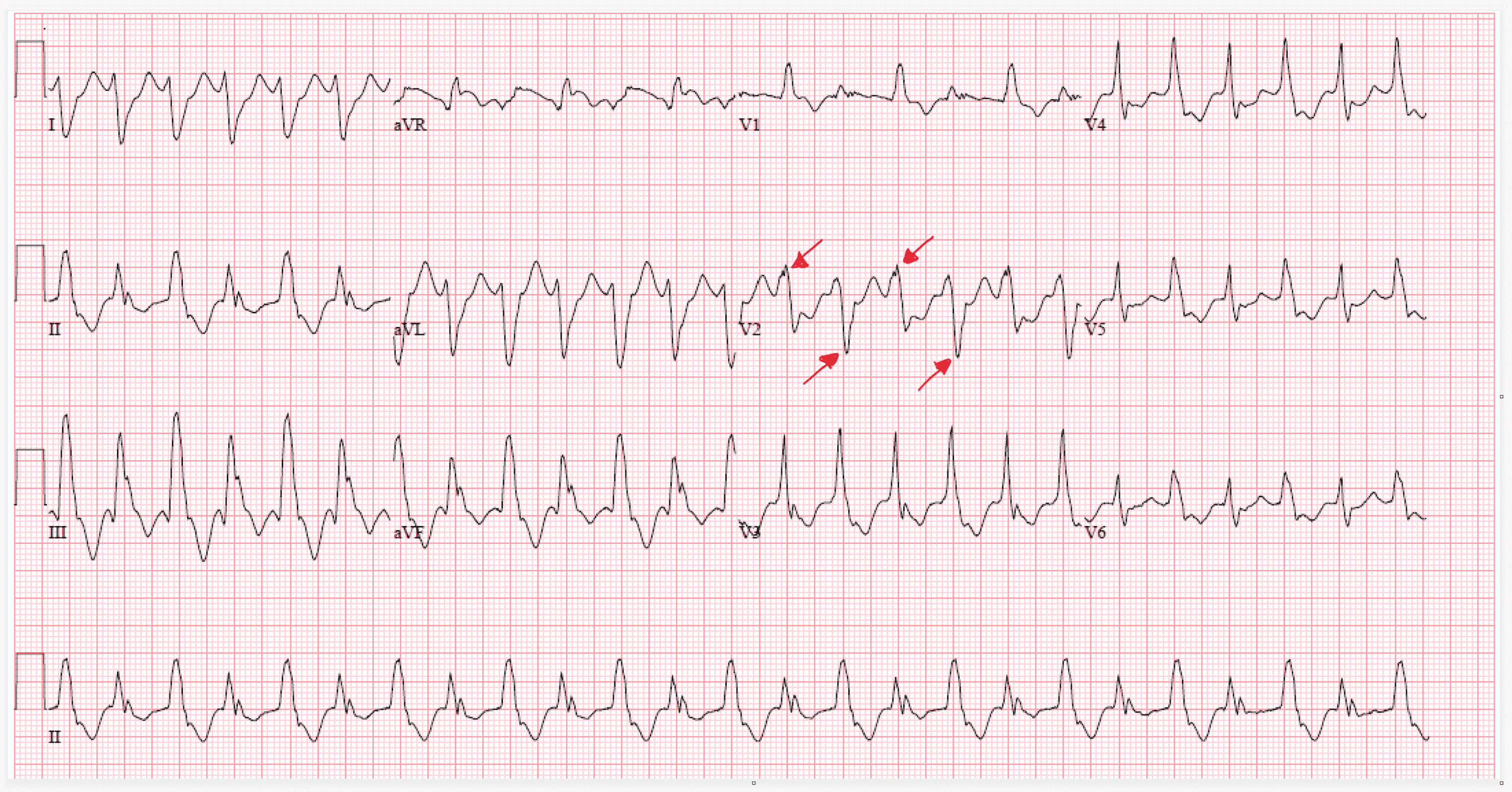 Cureus Bidirectional Ventricular Tachycardia in Acute Multivessel