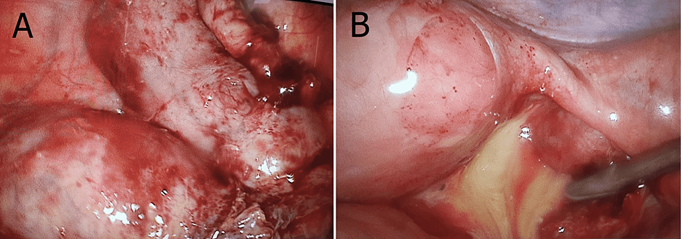 Torsion of paratubal cyst mimicking ovarian torsion: A rare case