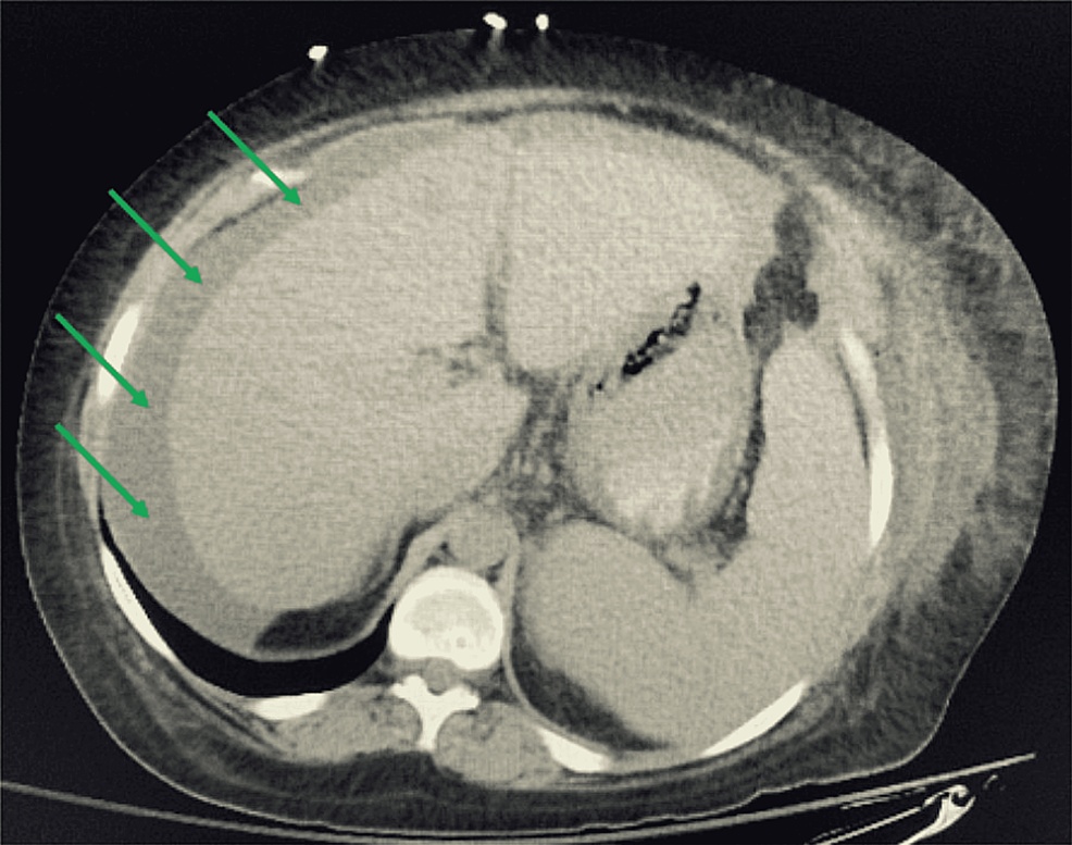 Representative-CT-image-of-the-abdomen-showing-ascites.