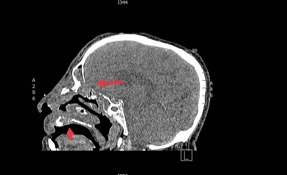 Sagittal-plane:-Cranial-computed-tomography-scan.