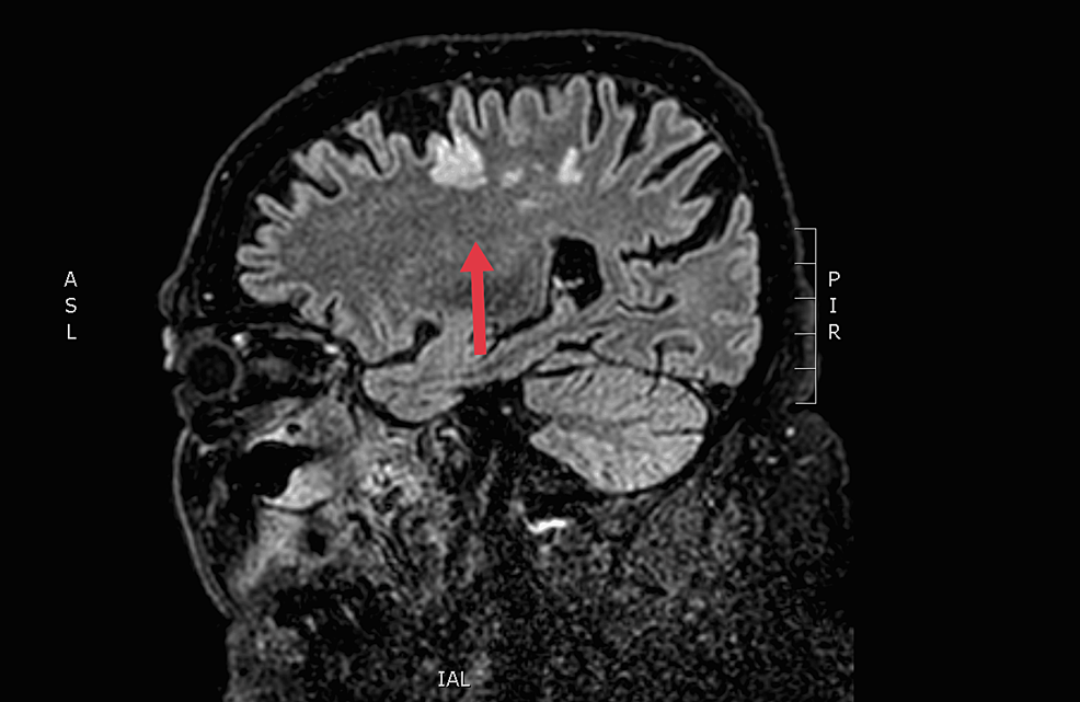 Brain-magnetic-resonance-imaging-of-the-patient:-Fluid-attenuated-inversion-recovery-after-the-first-surgical-intervention.