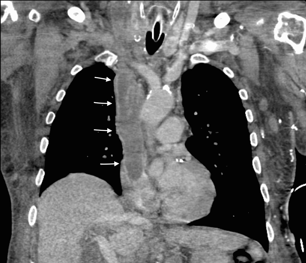 Coronal-chest-CT-scan-with-arrows-showing-thrombus-in-SVC-extending-to-right-atrium