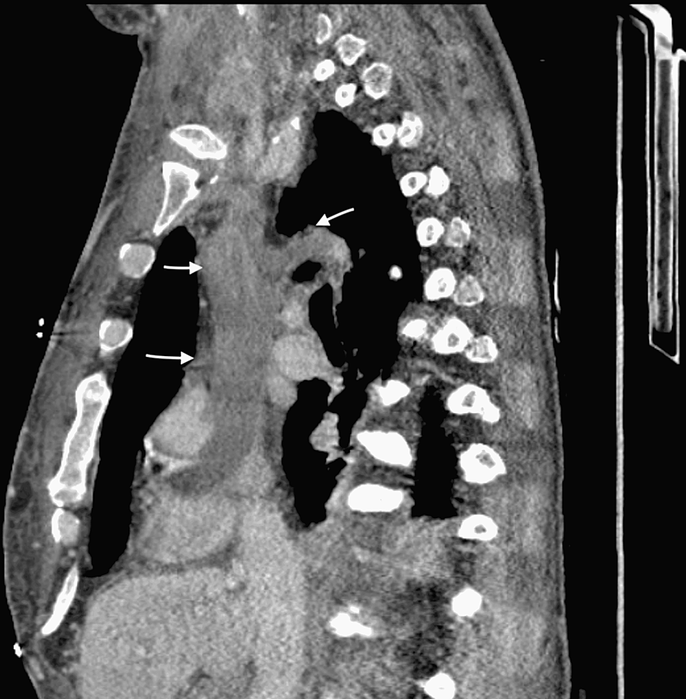 Sagittal-chest-CT-scan-with-arrows-showing-thrombus-in-SVC-and-azygos-vein