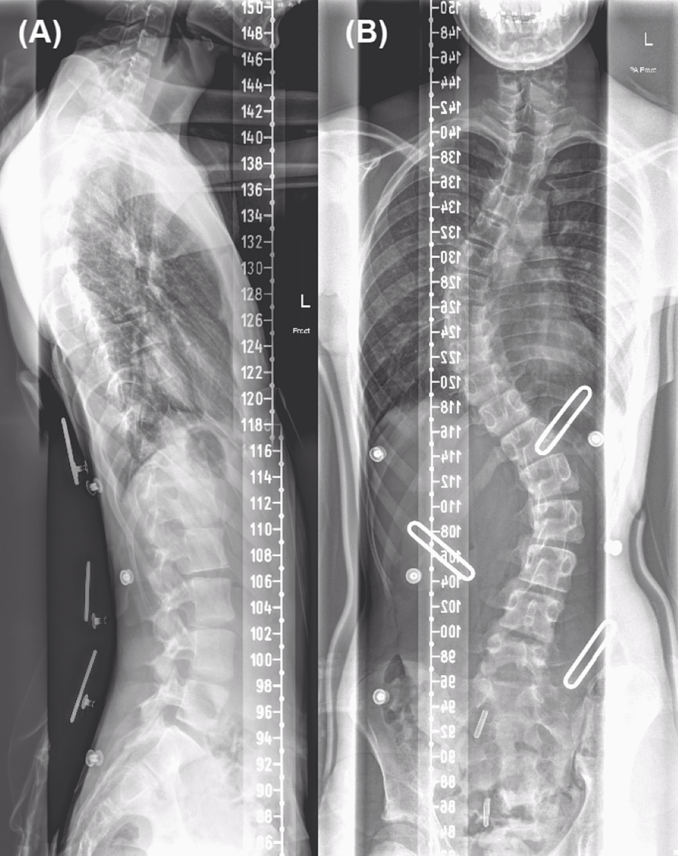 Post-operative Horner’s Syndrome: A Rare Complication Following ...