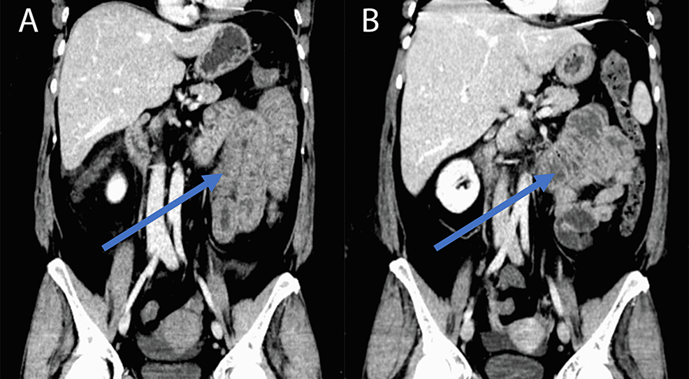 CT-abdomen-and-pelvis-with-contrast-(A)-on-day-of-admission-and-(B)-nine-days-later,-showing-some-improvement-of-pancolitis-(blue-arrow).
