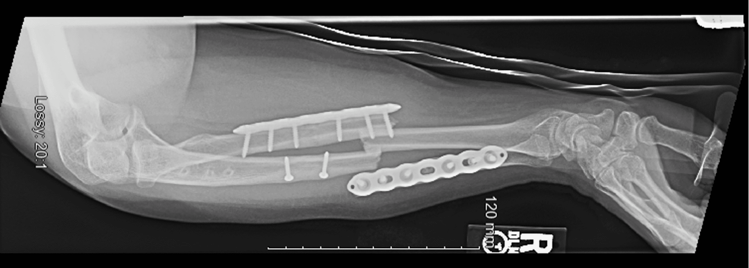 Cureus Intramedullary Nail and Plate Combination Technique for Peri