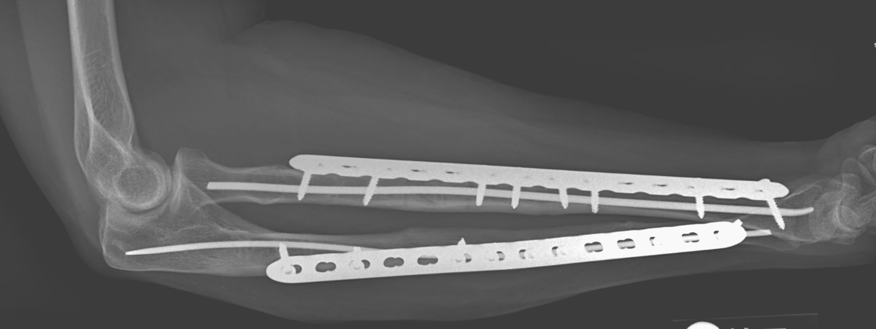 Cureus Intramedullary Nail and Plate Combination Technique for Peri
