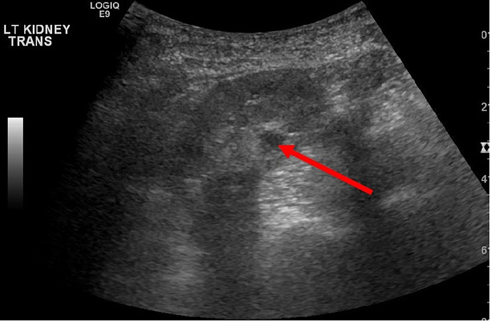 Subcutaneous Hematoma Ultrasound