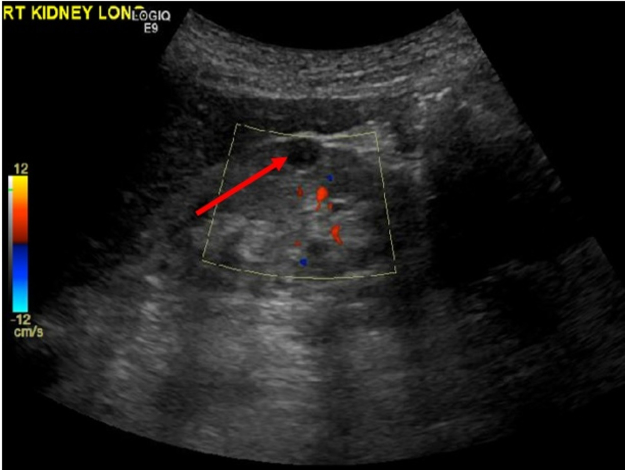 Subcutaneous Hematoma Ultrasound