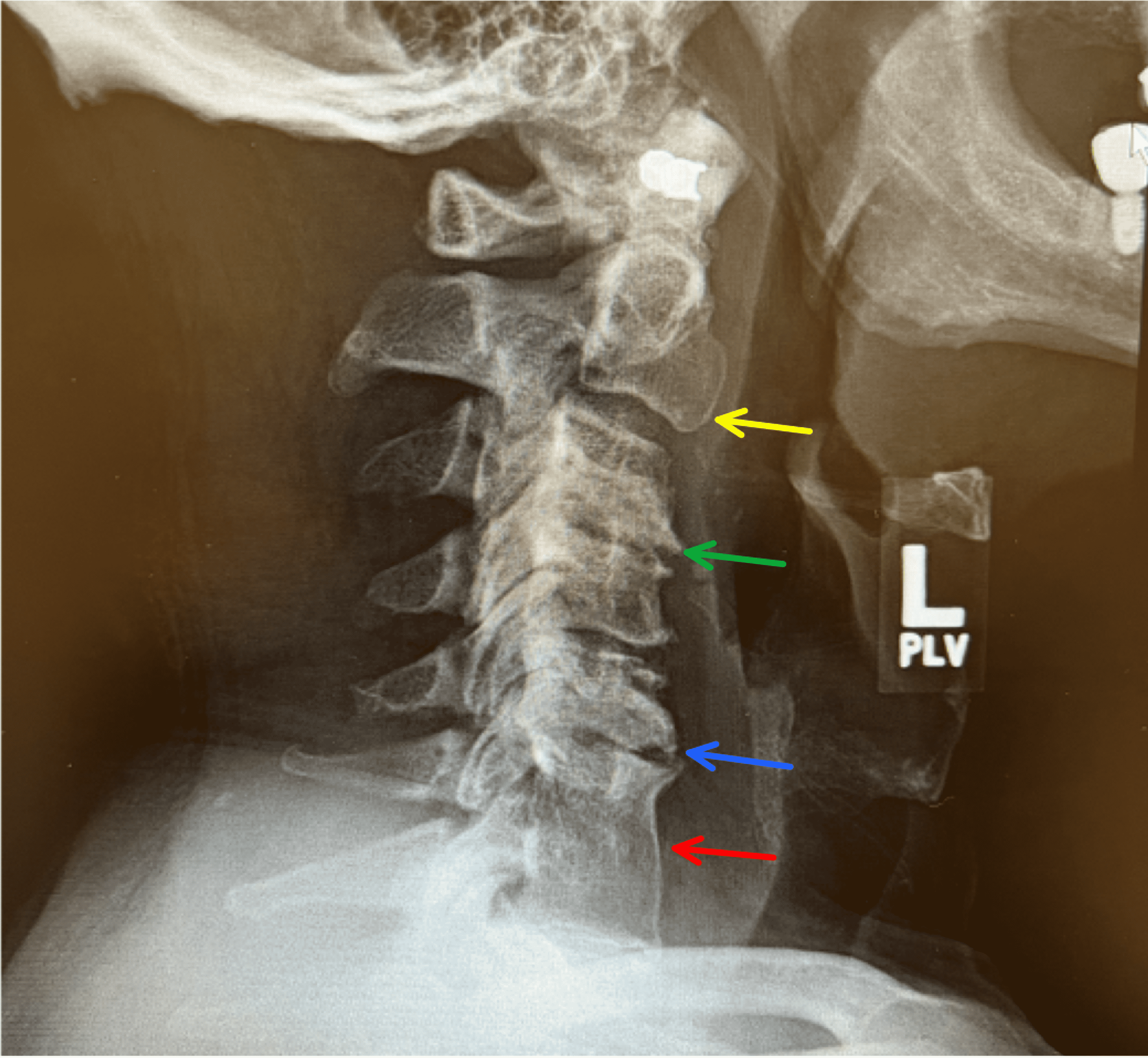 x ray of cervical spine