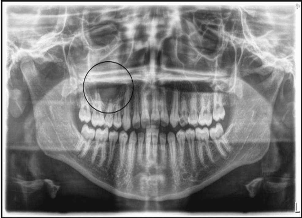 The-preoperative-panoramic-radiograph-that-was-presented-by-the-patient,-during-the-initial-consultation-visit,-showing-a-poor-quality-image-that-masks-the-presence-of-the-small-primary-remaining-root-in-the-upper-right-side-of-the-maxilla-(circle).-