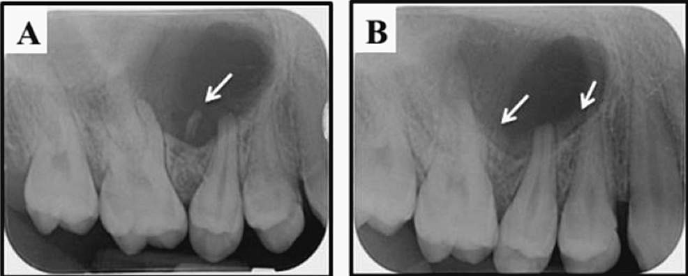 (A)-Preoperative-periapical-radiograph-clearly-showing-the-small-primary-remaining-root-between-the-roots-of-teeth-number-16-and-15-(arrow)-and-the-large-lesion-causing-diversion-to-the-number-#16-and-#15-roots.-(B)-Postoperative-periapical-radiograph-clearly-showing-the-successful-removal-of-the-small-primary-remaining-root-without-radiographically-affecting-any-of-the-associated-teeth-roots.-Bony-deposition-started-at-the-surgical-area-(arrows)-(three-month-follow-up).