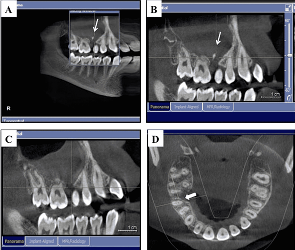 (A)-A-preoperative-representative-section-of-the-cone-beam-computed-tomography-(CBCT)-that-was-taken-during-the-initial-consultation-to-evaluate-the-size-and-extension-of-the-lesion-and-clearly-showing-the-small-primary-remaining-root-between-the-roots-of-teeth-16-and-15.-(B)-A-close-up-view.-(C)-A-postoperative-representative-section-(three-month-follow-up)-of-the-CBCT-demonstrating-the-successful-removal-of-the-primary-remaining-root.-(D)-A-postoperative-representative-section-showing-the-bony-deposition-starting-at-the-surgical-area-(arrows)-(three-month-follow-up).