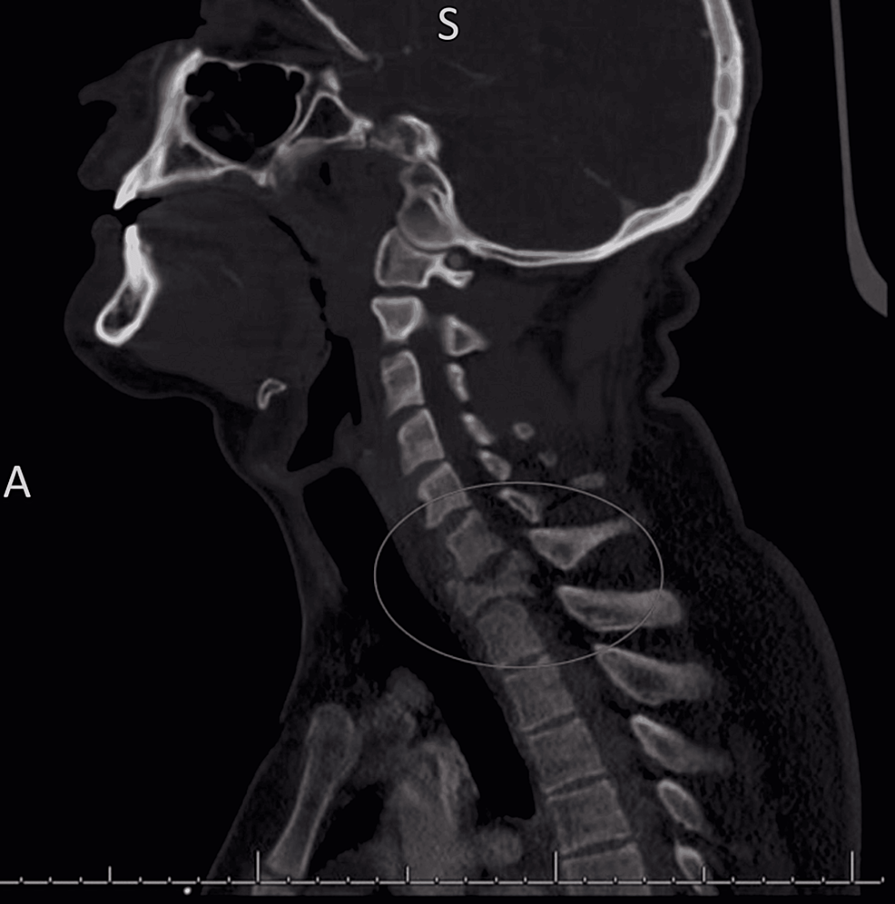 Cureus Acute Basilar Artery Occlusion and Death Secondary to