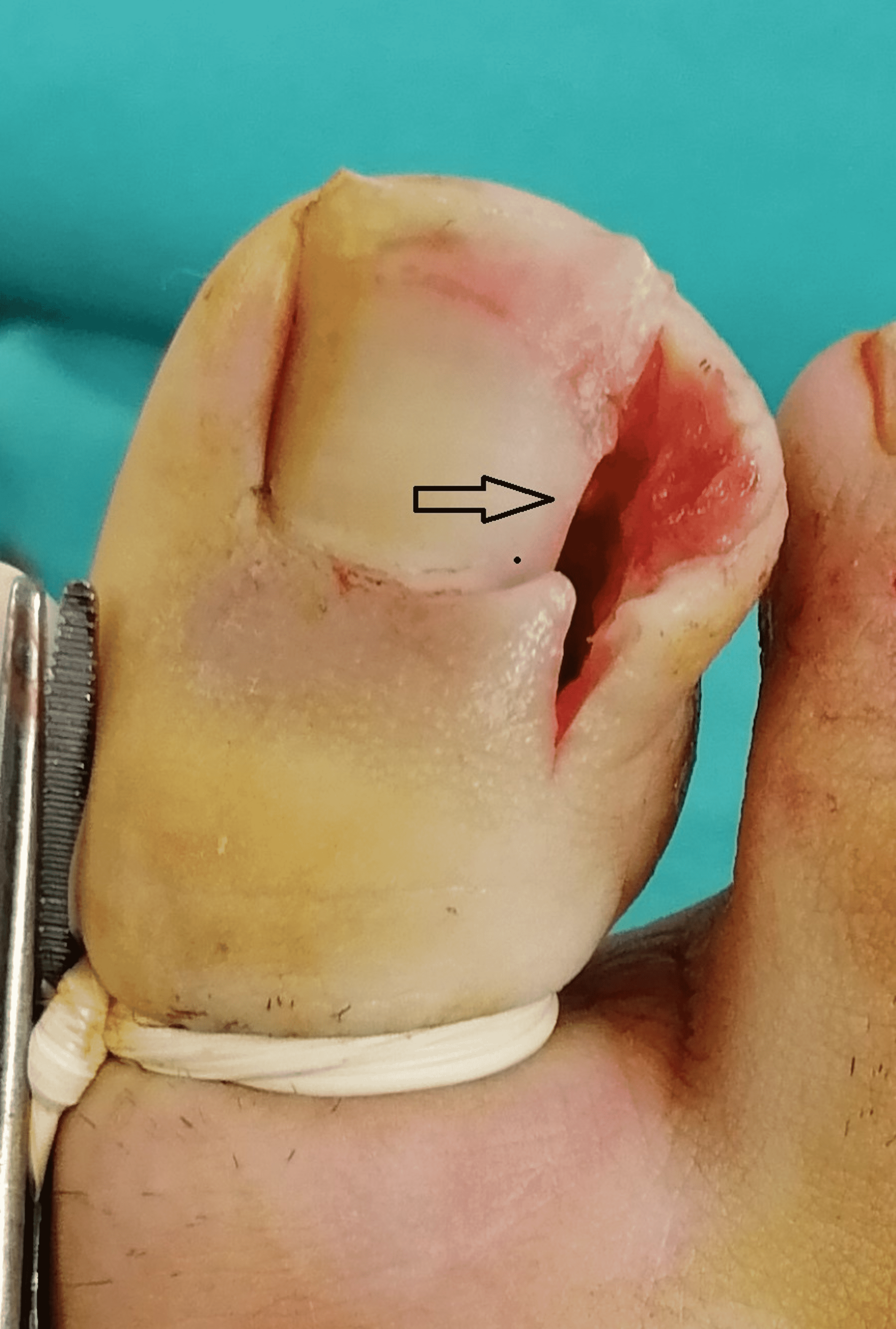 Cureus | A Comparison of Clinical Outcomes Between the Winograd and  Modified Winograd Methods for Ingrown Toenails: A Retrospective Study of  the Importance of Suturing Techniques | Article
