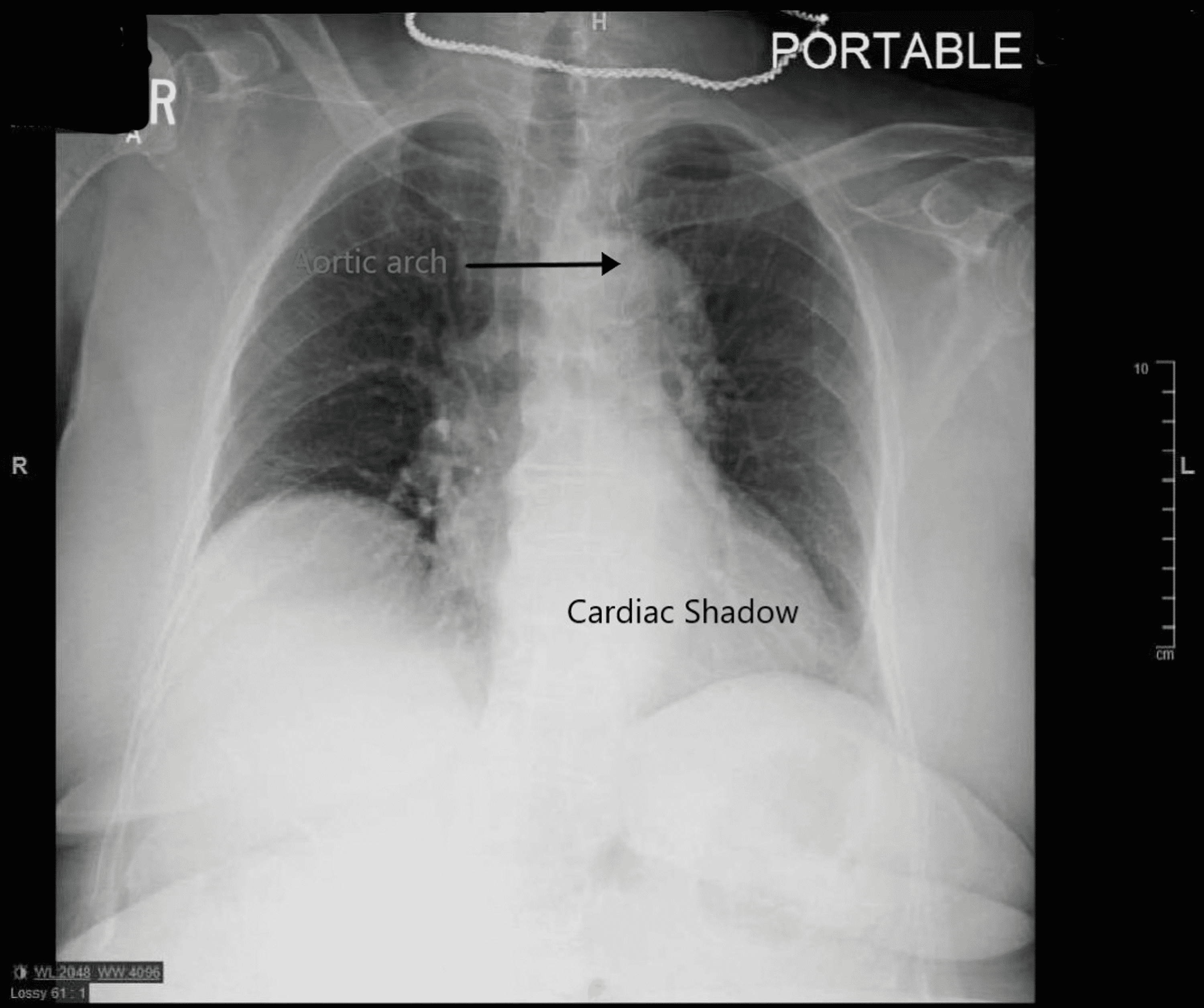 Cureus | Bovine Aortic Arch, A High-Risk Variant