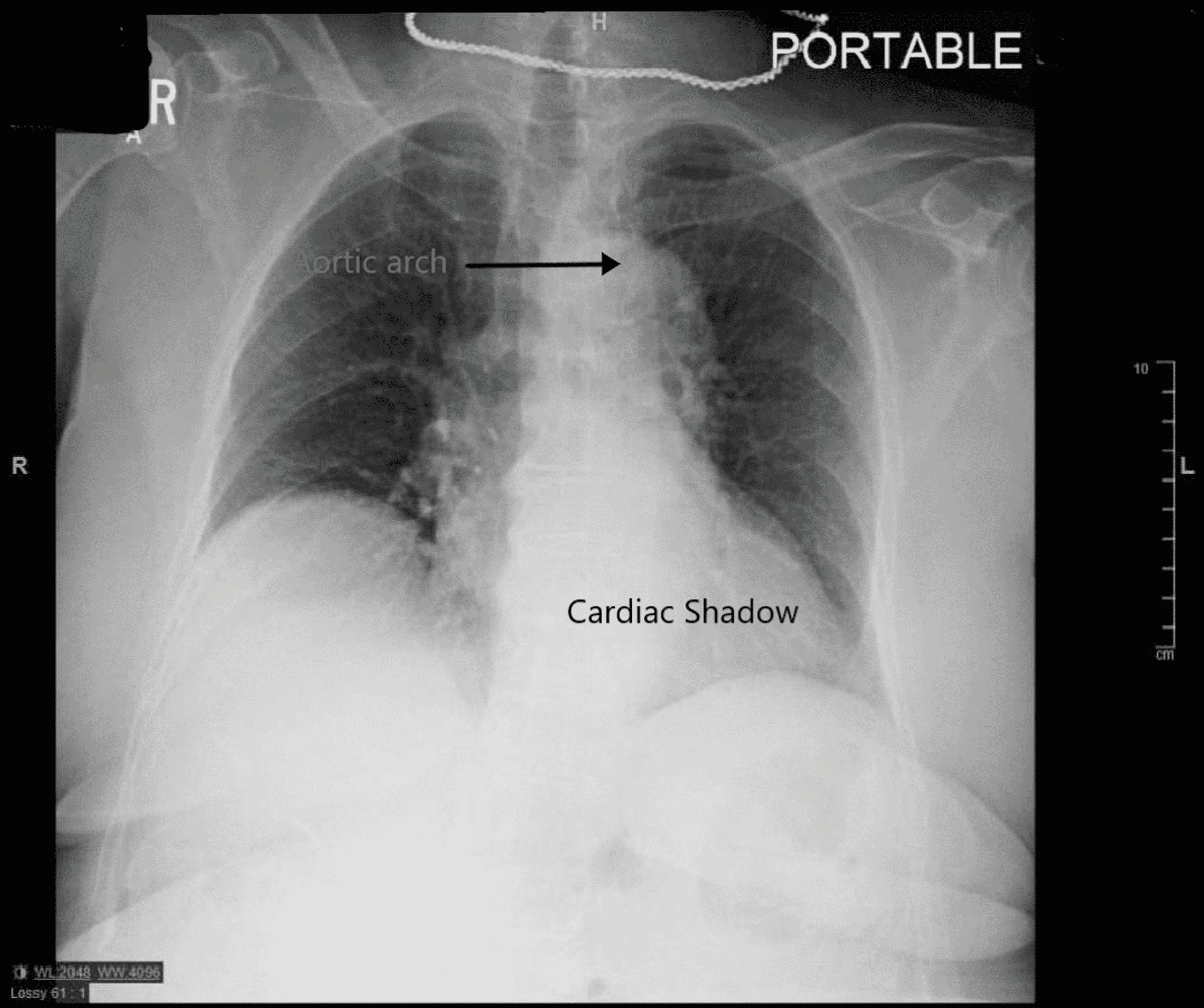 Cureus Bovine Aortic Arch A High Risk Variant