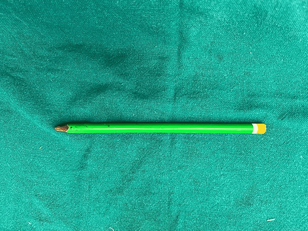 Cureus A Self Inserted Unusual Foreign Body “An Entire Pencil” in a