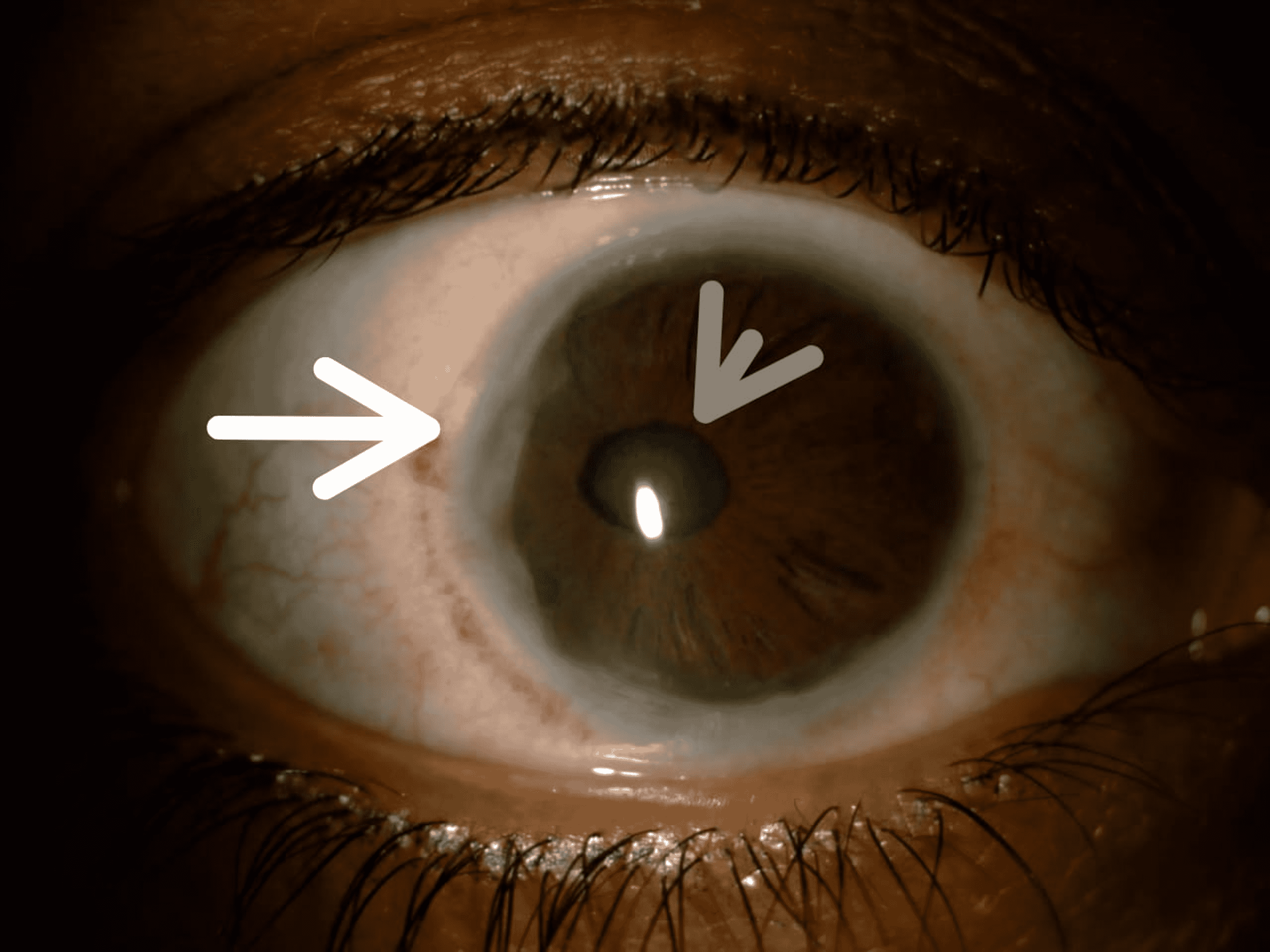 Cureus | Progressive Vision Loss in a Patient With Axenfeld-Rieger Syndrome