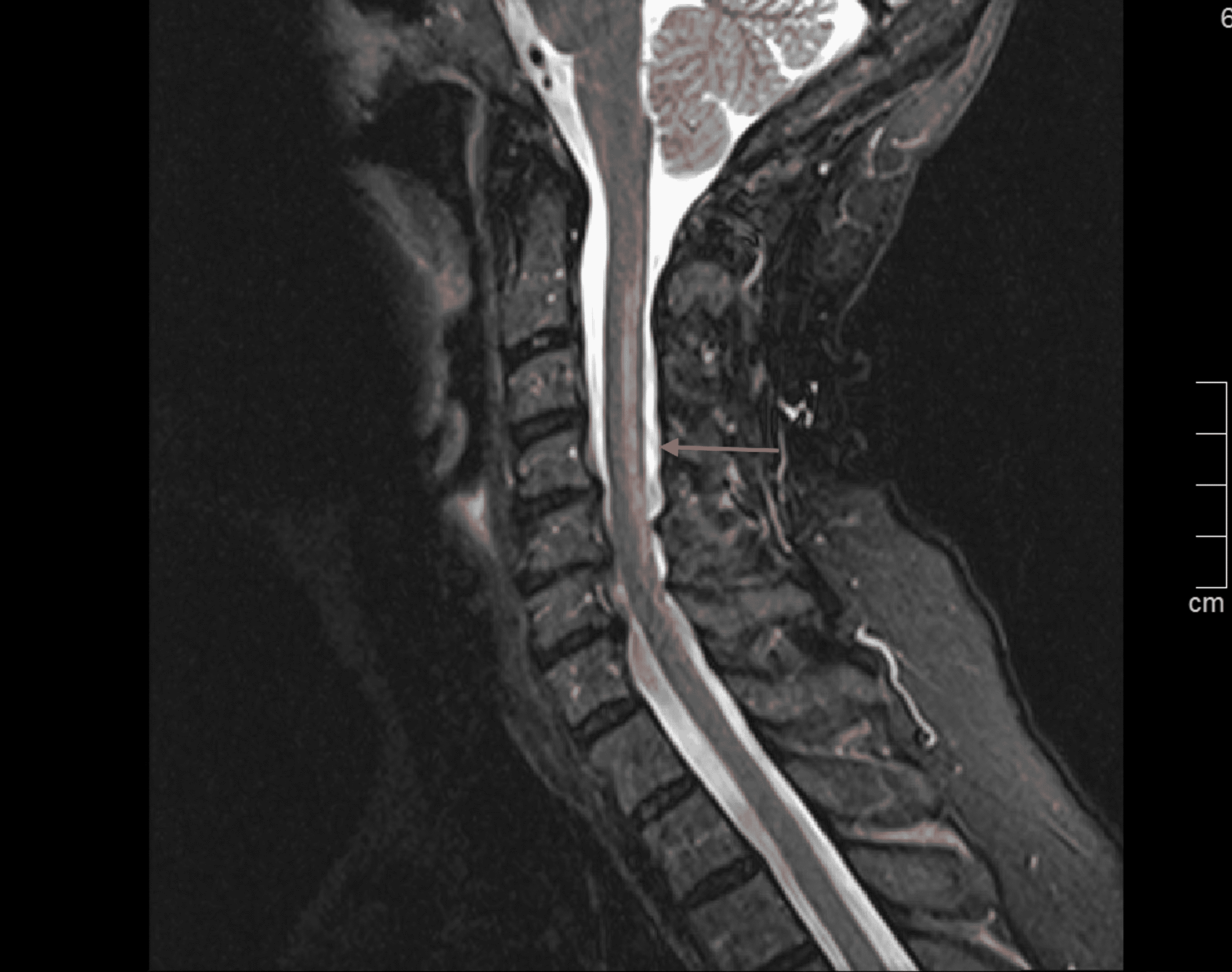Cureus Copper Deficiency Myeloneuropathy Following RouxenY Gastric