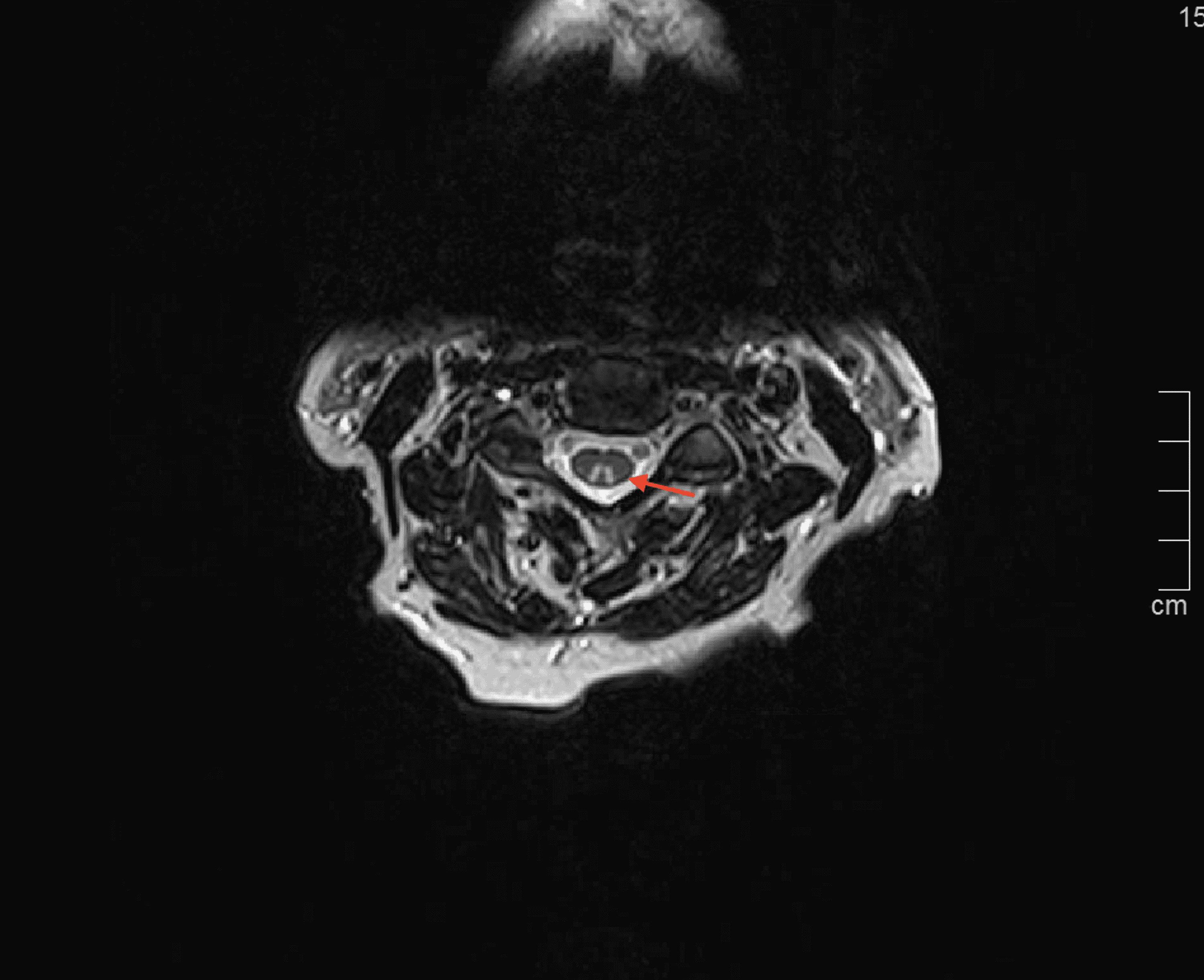 Cureus Copper Deficiency Myeloneuropathy Following RouxenY Gastric