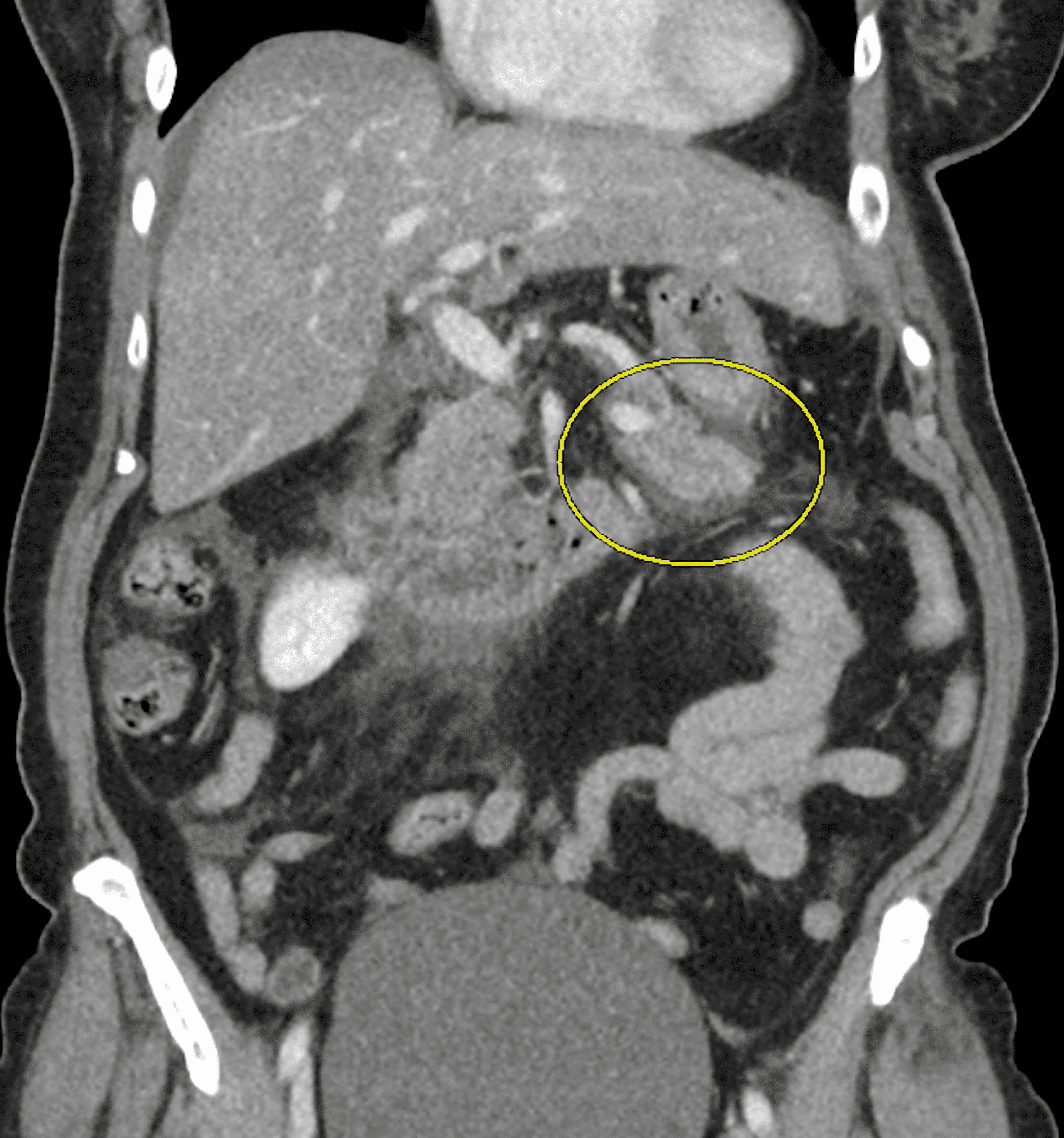 Cureus | Empagliflozin-Induced Pancreatitis: A Case Report Pattern