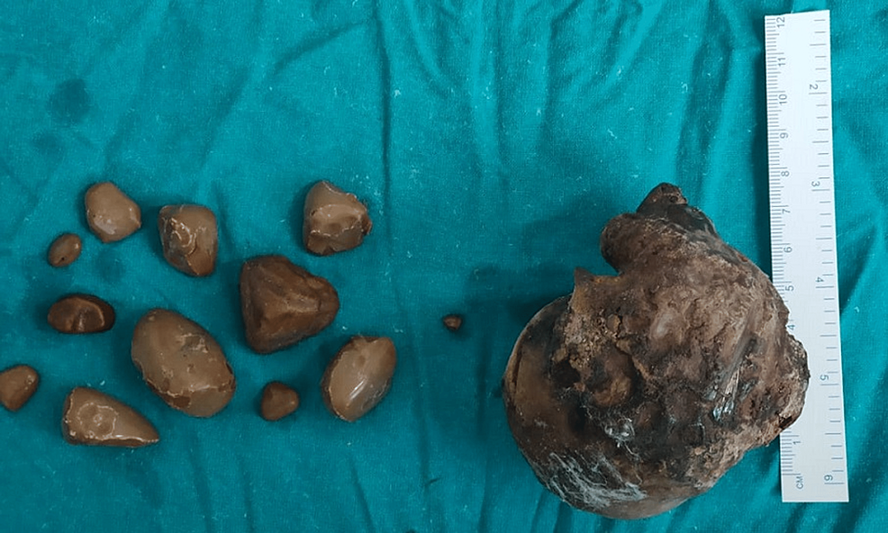 Horseshoe Kidney With a Documented Giant Calculi A Case Report Cureus