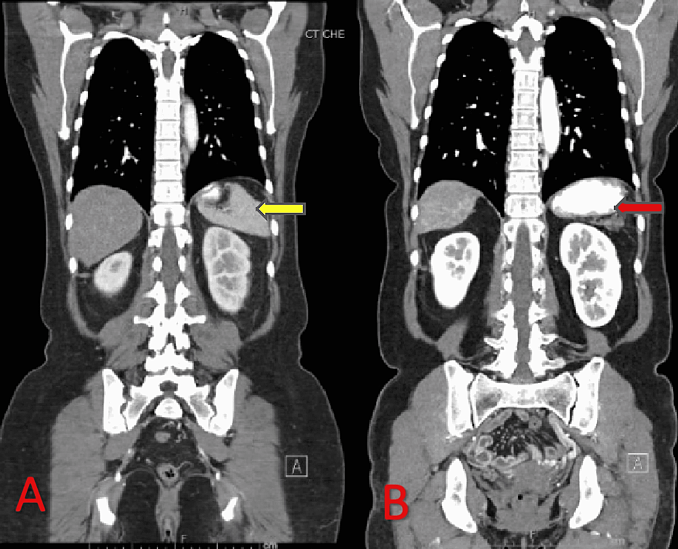 CT-contrast-coronal-images-of-(A)-pre-therapy-and-(B)-post-therapy-showing-significantly-decreased-size-of-the-spleen-on-the-post-therapy-image-(red-arrow)-compared-to-the-pre-therapy-image-(yellow-arrow).