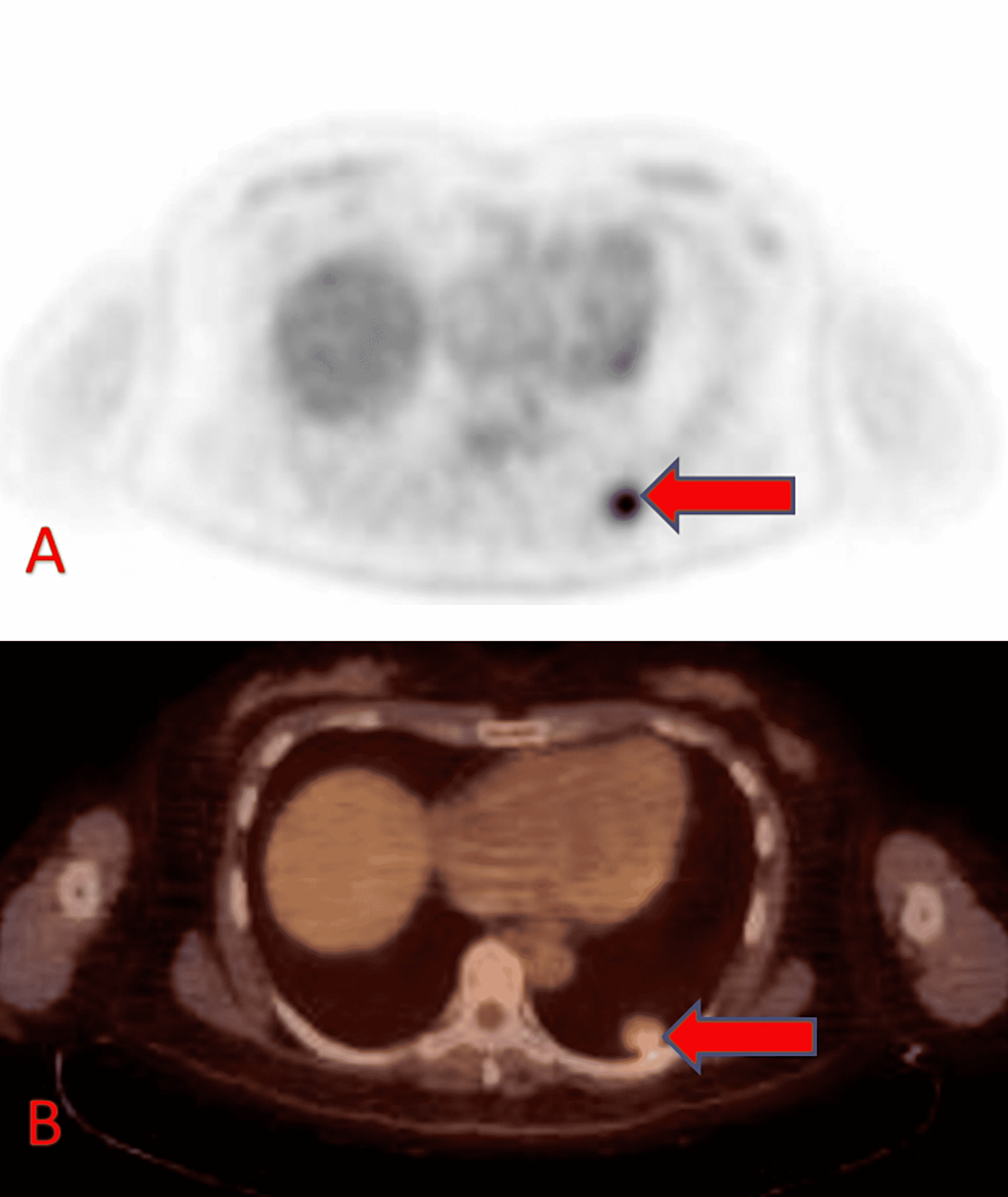 Axial-FDG-PET-(A)-and-fused-PET-CT-(B)-showing-moderate-FDG-uptake-in-the-left-lower-lobe-lung-nodule-(arrows).-