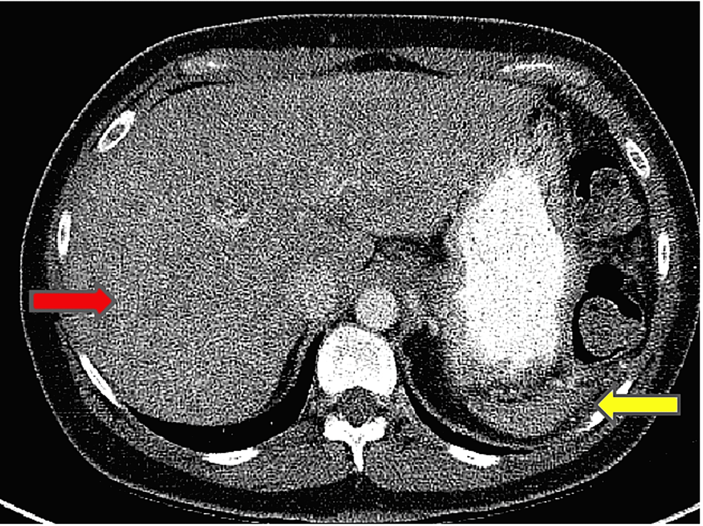 Post-therapy-CT-contrast-axial-slice-showing-the-heterogeneous-appearance-of-the-liver-secondary-to-innumerable-hypodense-hepatic-lesions-(red-arrow).-A-small-sized-spleen-is-also-noted-(yellow-arrow).--