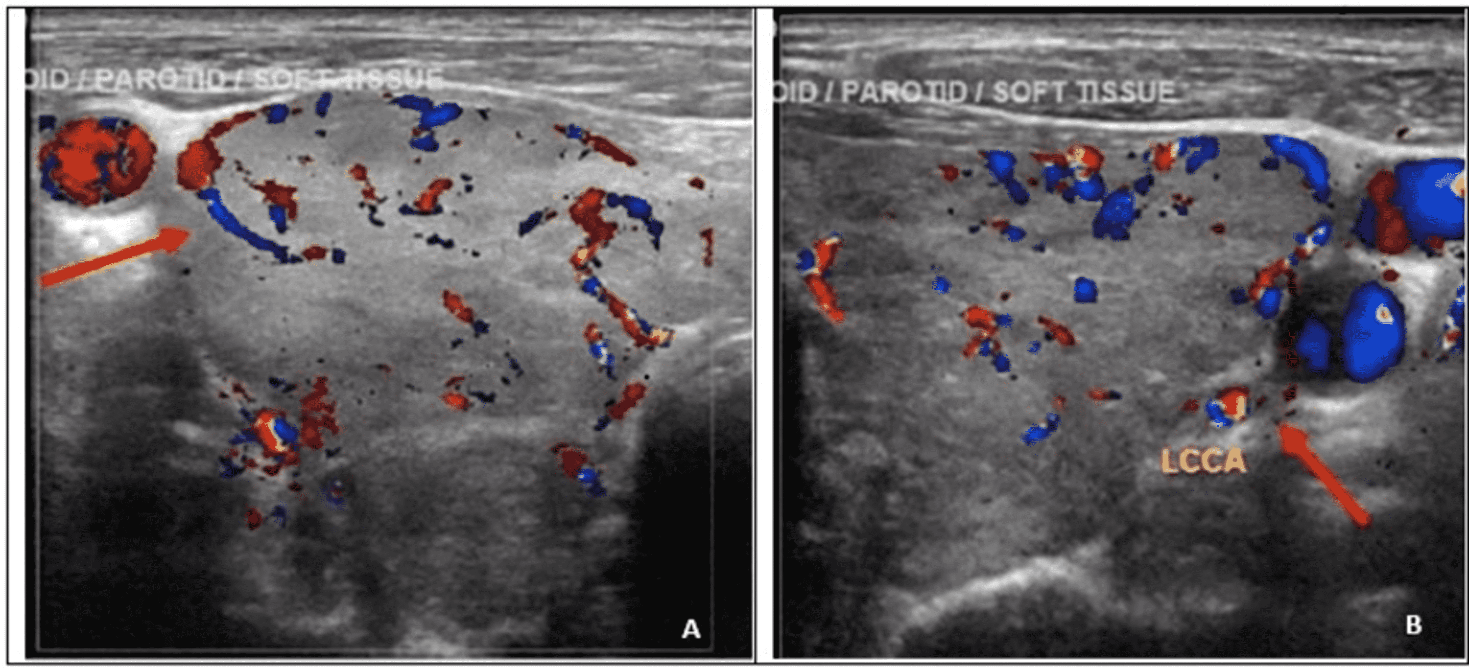 Cureus Unprovoked Isolated Pulmonary Embolism and Graves’ Disease in
