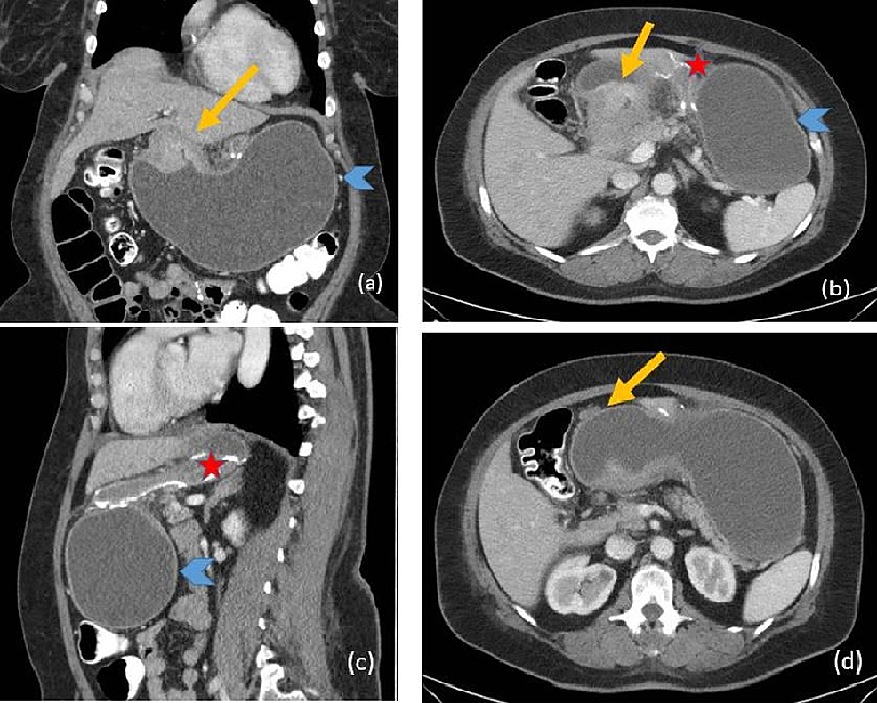 Cureus Exploring The Excluded Stomach A Case Series Of Novel   Article River 3c2a4160622e11e89b8577cb030596a7 Fig 2 